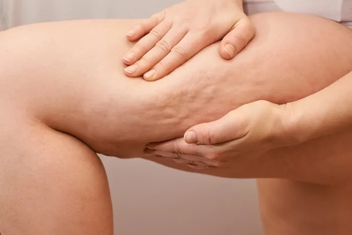 Cellulite – so könnt Ihr Euer Hautbild verbessern