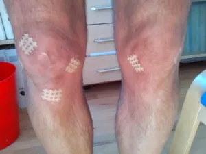 Tapen bei Arthrose