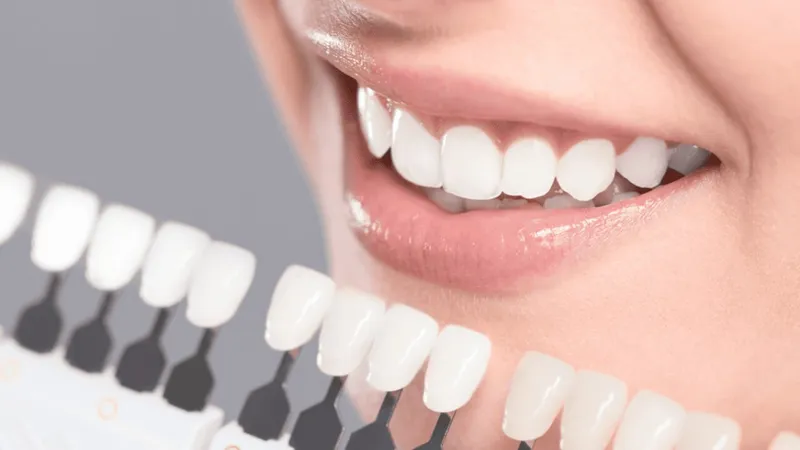 Veneers im Schnellcheck: Wie vorteilhaft sind die Verblendschalen?