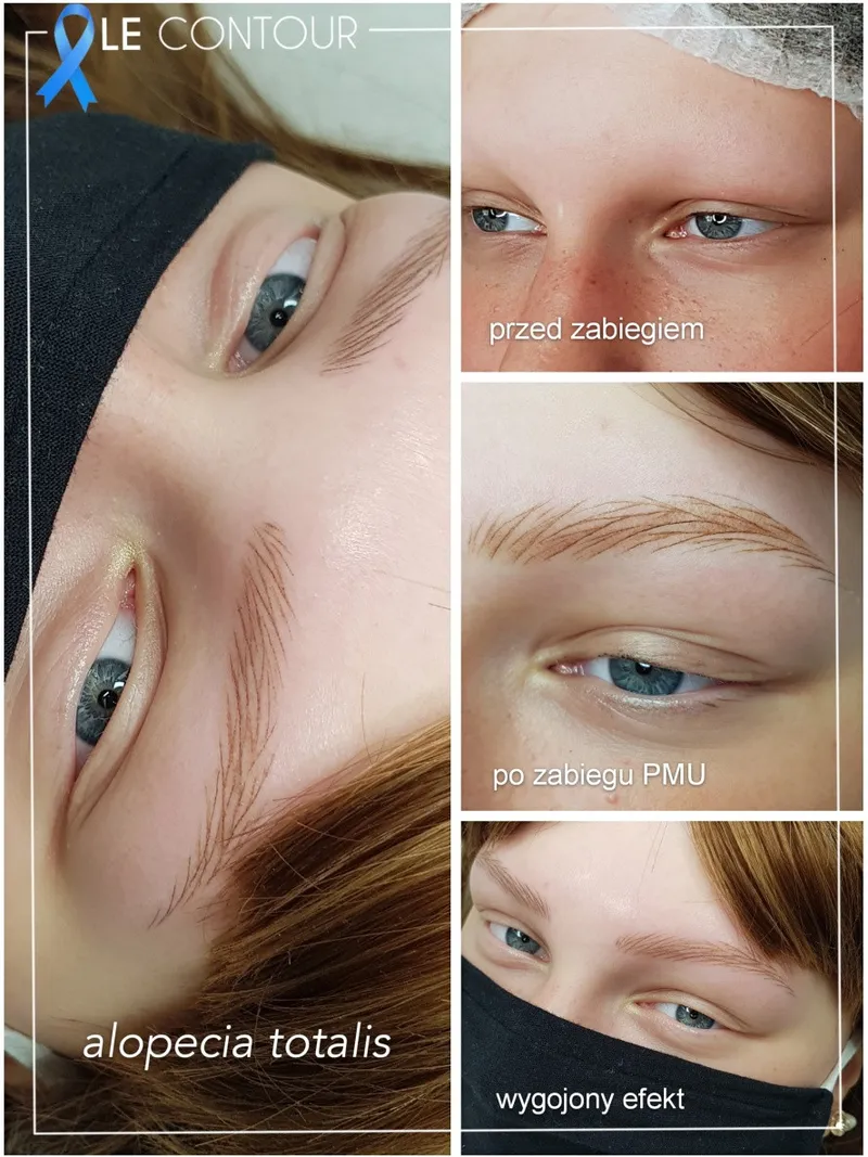 Permanent Make-Up bei Alopezie (Übermäßiger Haarausfall, Alopecia Areata, Alopecia Totalis )