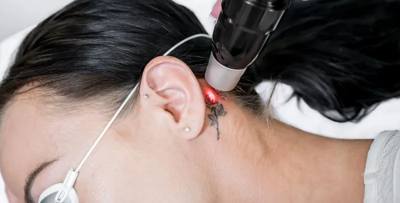 Tattoo-Entfernung dank Laser