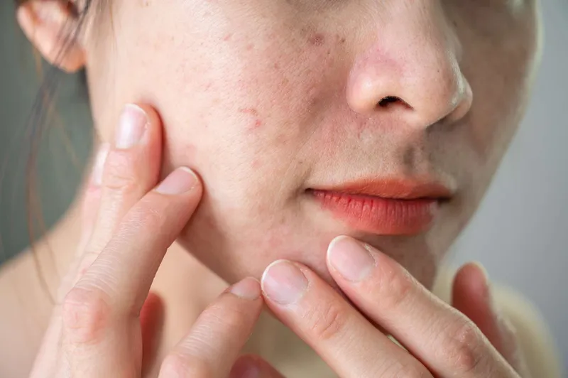Facial Treatments for Uneven Skin Texture: How to Get Smoother Skin?
