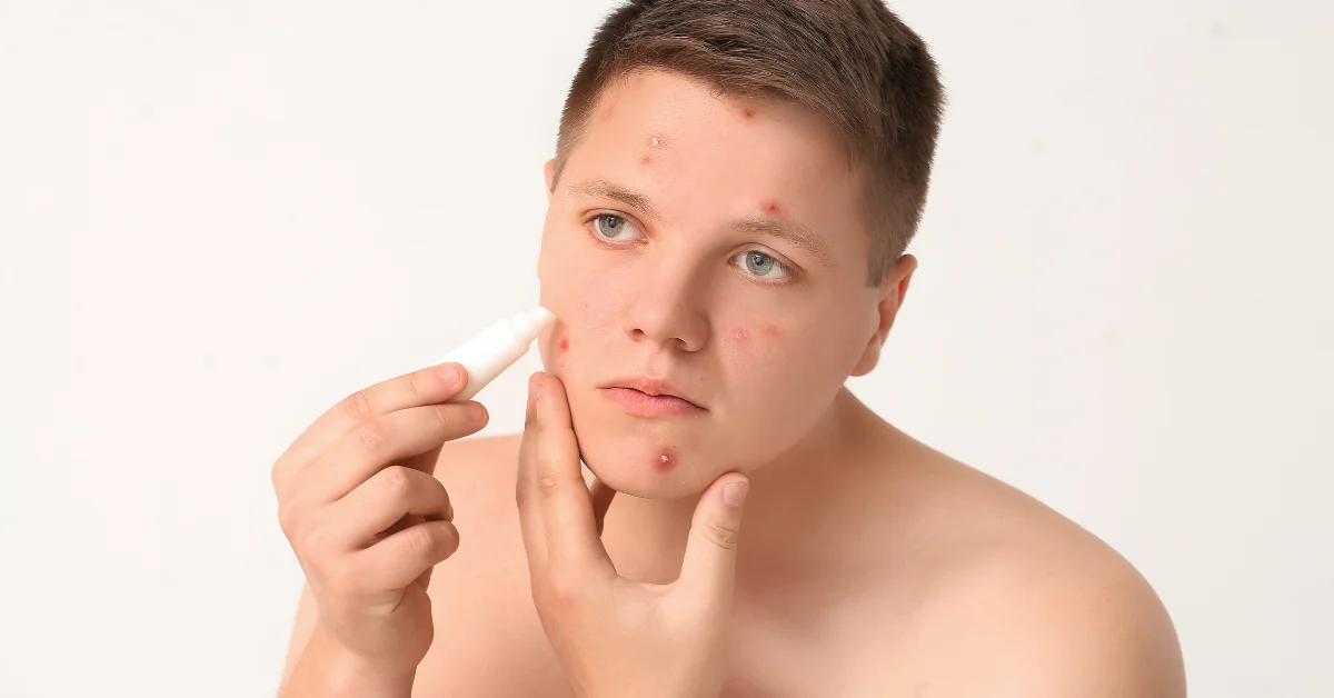 ▷ Skincure.de | Experten-Tipps zu Hautpflege, Akne & Pickel